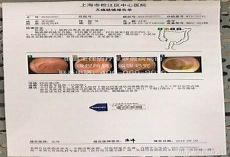 罗恩华西正颌失败