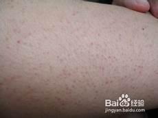鸡皮疙瘩怎么去除